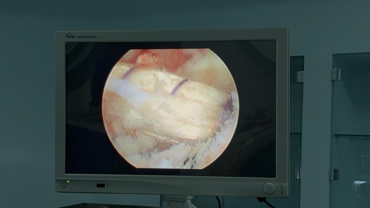 Arthroscopic camera view inside the knee joint