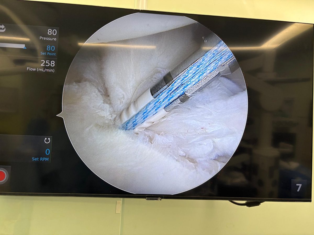 Arthroscopic view of a rotator cuff repair