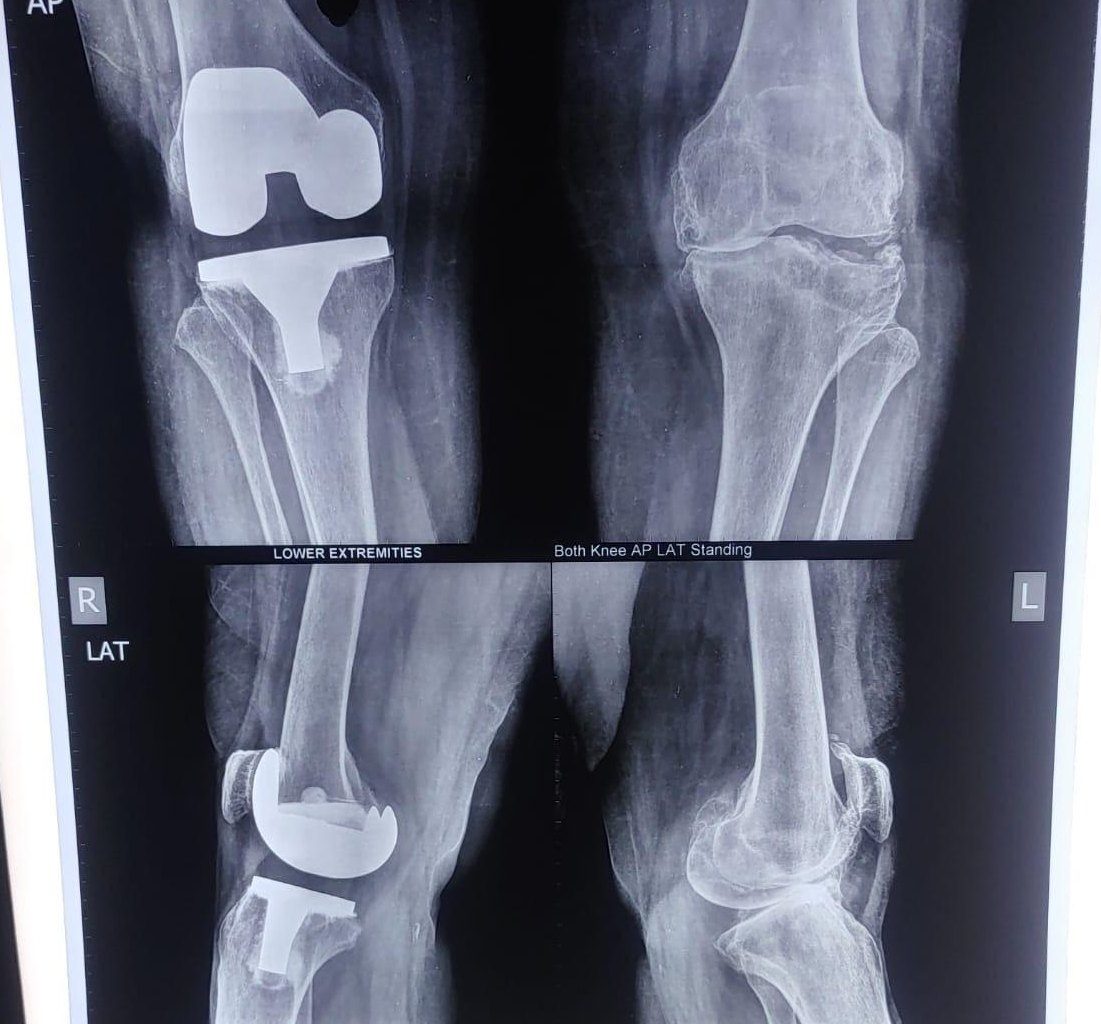 Radiograph after total knee replacement, standing AP and lateral views