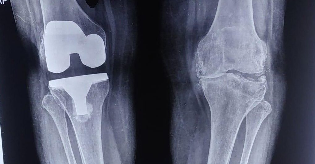 Standing X-ray of both knees from the front: one already replaced, the other worn by arthritis