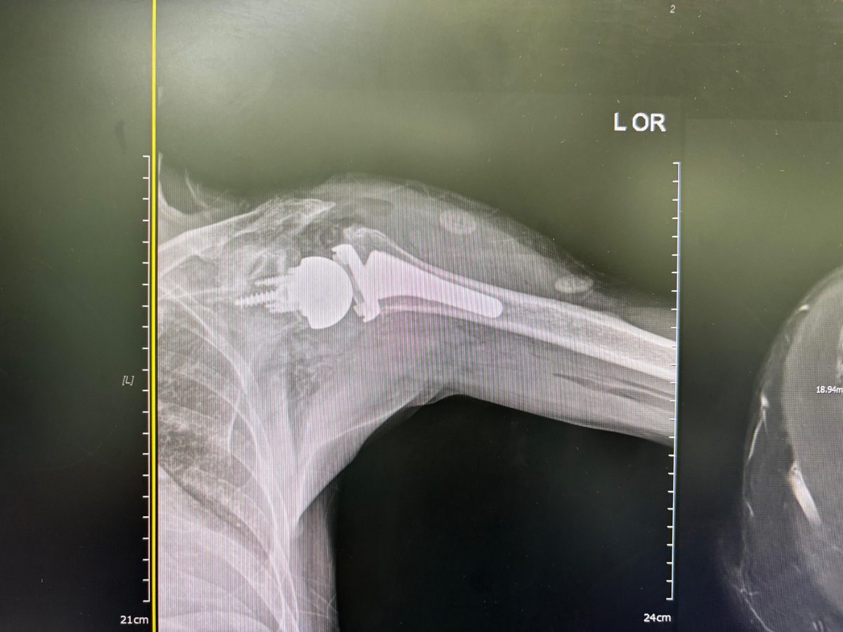 Radiograph after reverse shoulder replacement