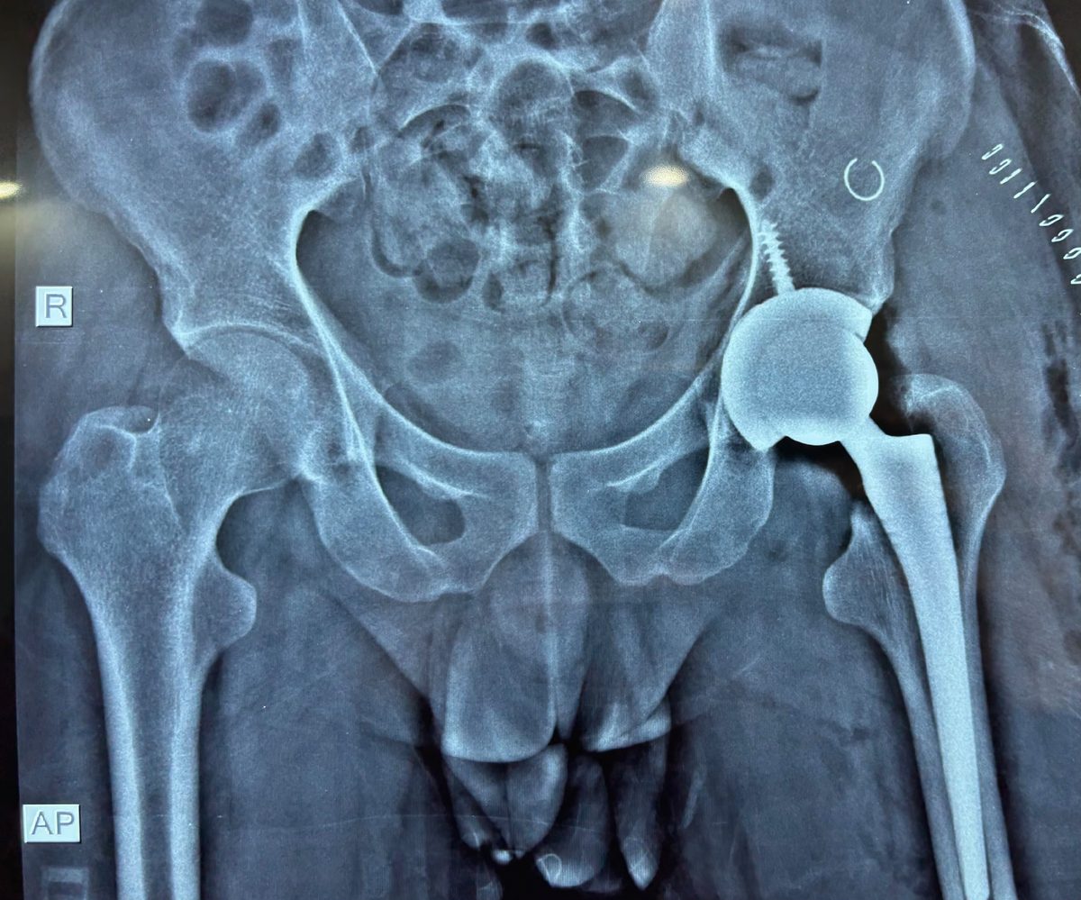 X-ray of the pelvis after a left total hip replacement
