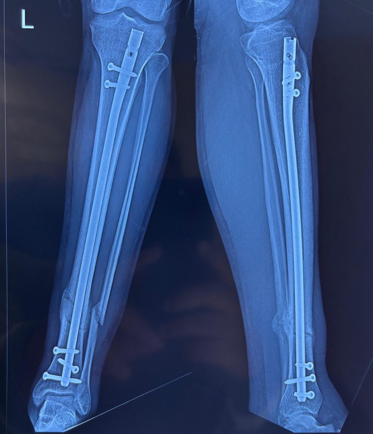 Radiograph after tibia fracture fixation with an intramedullary nail
