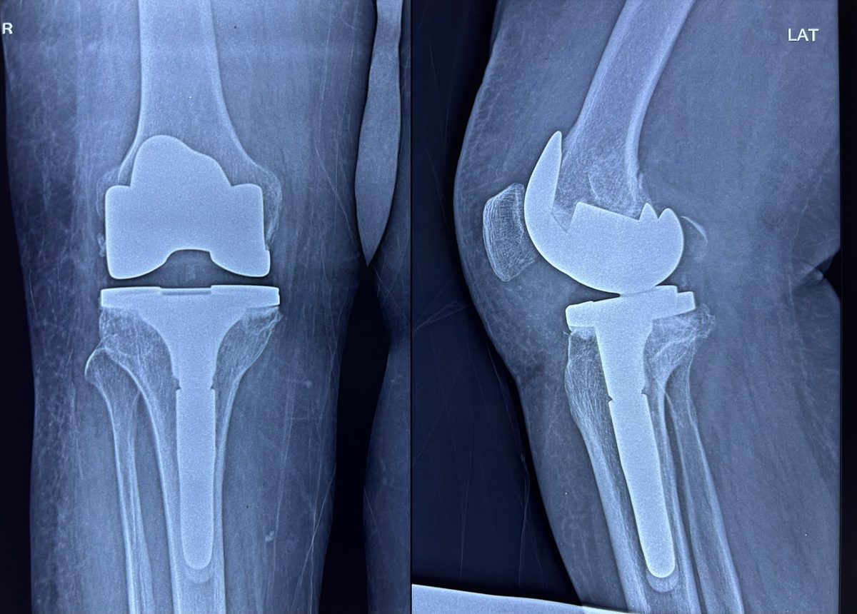 X-rays of a knee after total knee replacement, from the front and from the side